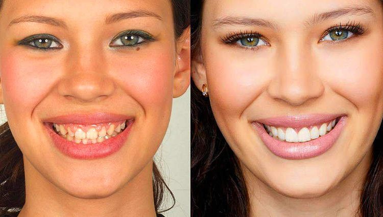 Lente de contato dental é feita sob medida | Foto: Reprodução