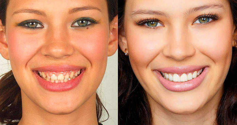 Lente de contato dental é feita sob medida | Foto: Reprodução