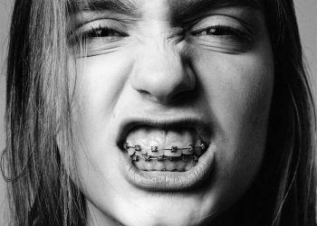 Aparelho pode corrigir outros problemas além da estética? Confira as 7 perguntas e respostas