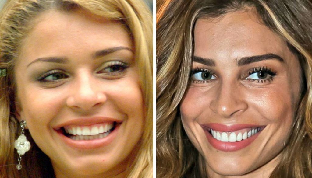 Veja tudo o que precisa saber antes de colocar facetas dentárias em Goiânia. A atriz Grazi Massafera já passou pelo procedimento| Foto: Reprodução