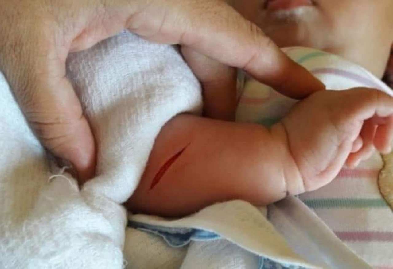 bebê esfaqueado precisou levar quatro pontos no braço direito após ser alvo de assaltante | Foto: Reprodução