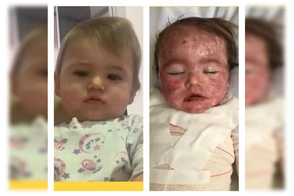 Alergia a remédio deixa bebê com graves queimaduras em Anápolis