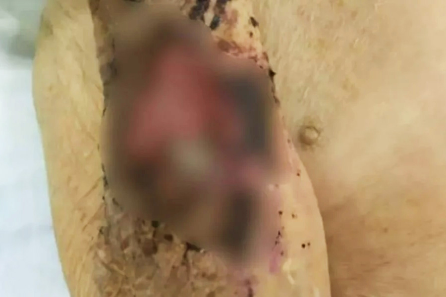 Idoso é resgatado com feridas cheias de larvas e filho é preso em Goiânia