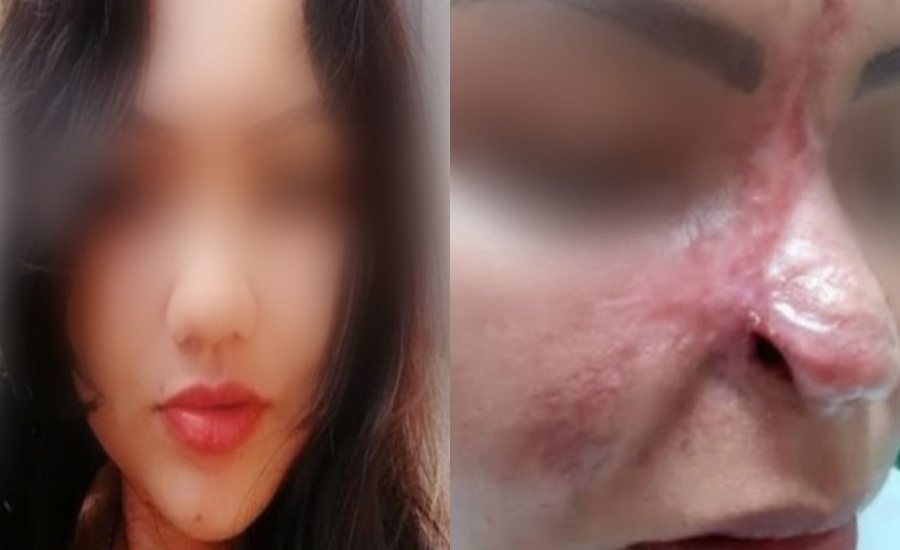 Após cirurgia estética, mulher quase perde o nariz | Foto: PC
