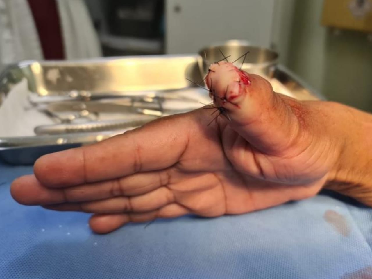 Subtenente passou por cirurgia, mas parte do dedo não pode ser recuperado | Foto: PM