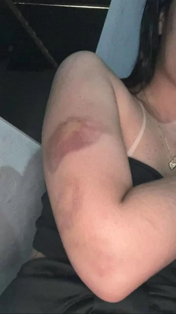Hematomas no corpo de Ielly por agressões de Diego | Foto: Reprodução